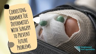 Correcting Hammer Toe Deformities With Surgery to Prevent Future Problems [upl. by Aiekahs]