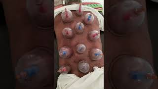 Dry cupping therapy back pain relief treatment [upl. by Ahsinawt]