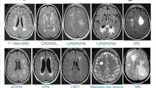 MRI Uses in MS [upl. by Arabele]