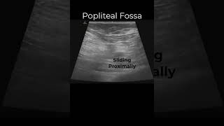 Popliteal Sciatic Nerve Block emergencymedicine regionalanesthesia POCUS FOAMed FOAMus [upl. by Carena]