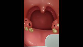 Treatment of oral gingivitis asmr shorts [upl. by Brooke]