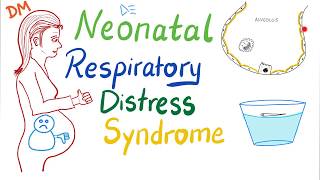 Neonatal Respiratory Distress Syndrome NRDS  Pediatrics  Pulmonology [upl. by Jovitta272]