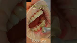 Carillas de resina como quedan dientes esteticadental dientesblancos [upl. by Bonnee]