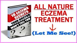 Eczema Treatment  How To Get Rid Of Eczema Naturally [upl. by Otinauj]