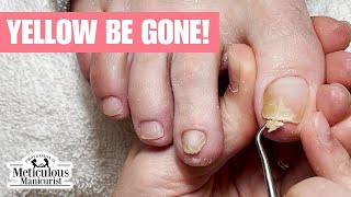 Why Are My Toenails Turning Yellow nails satisfying [upl. by Atilrahc]