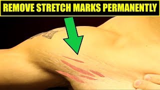 How To Get Rid Of Stretch Marks  4 Easy Tips To REMOVE STRETCH MARKS [upl. by Jolyn]