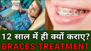 Braces Treatment आखिर 1213 साल तक क्यों हो जाना चाहिए [upl. by Gaven]