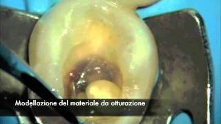 Dr Enrico Cogo  Otturazione estetica [upl. by Yecac]