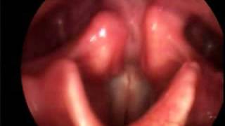 Singing Vocal Folds [upl. by Haliak]