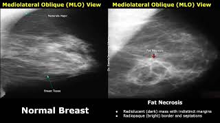 Mammography Normal Vs Abnormal Images  BIRADS Classification  Breast Cancer amp Other Diseases [upl. by Felicidad]