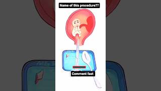 Comment the procedure procedure medical medicalprocedurevideos medicalprocedure medicalstudent [upl. by Greerson977]