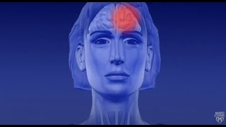 Learn About Migraine Aura [upl. by Lewie150]