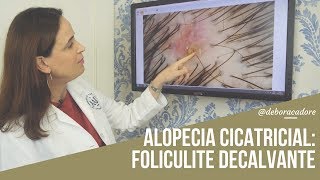 Alopecias Cicatriciais Foliculite Decalvante [upl. by Nosidda]