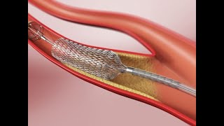 Angioplastia Carotídea [upl. by Krystin]