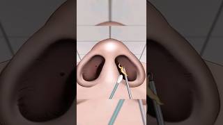 ASMR Remove unmanaged piercing pus animation  Squeeze nose acne asmr shorts [upl. by Peisch]