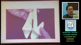 Dr James Hui Triplane and Tillaux Ankle Fractures [upl. by Silirama916]