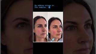 Sculptra The Biostimulatory Injectable for Collagen Production aobmedspa medspa [upl. by Hoisch]