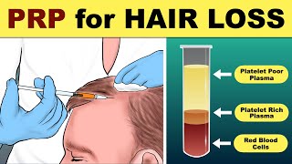 PRP Hair Treatment  prp hair loss treatment before and after  Hair loss Treatment [upl. by Belshin146]