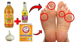 14 Proven Home Remedies For Corns amp Callus Removal THAT WORK [upl. by Devehcoy425]