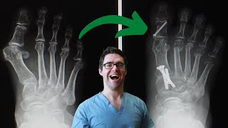 6 Best Bunion Surgery Pros amp Cons Get the FASTEST Recovery Time [upl. by Arata]