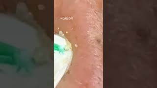 Pickel Ausdrücken Blackheads Akne amp Mitesser entfernen 🔴 24 [upl. by Gareri499]