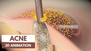 Acne basics  Pathophysiology amp Treatment  3D Animation [upl. by Engvall]