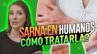 🔴 ¡CUIDADO SI SIENTES ESTO puedes TENER SARNA o ESCABIOSIS drapilarochoa  Dermatologa [upl. by Ociredef]