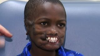 Boy Mauled By Chimps to Undergo Facial Surgery [upl. by Jorey419]