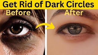 Say Goodbye to Dark Circles Natural Remedies to Get Rid of Under Eyes Dark Circles [upl. by Seuguh]