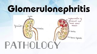 Glomerulonephritis Pathology [upl. by Cordi]