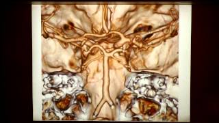 3D CT Angiography [upl. by Larkin]