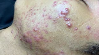 ACNE TREATMENT VU QUYNH MI  Blackheads Of Tweens 2024 EX [upl. by Wadsworth752]