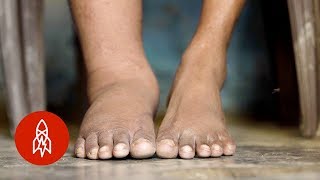 Racing to End Elephantiasis in India [upl. by Aihn]