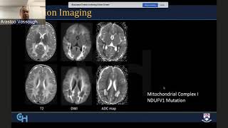 Radiological Diagnosis and Approach to Leukodystrophies [upl. by Nillek]