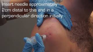 Injection Technique into the Subacromial Space for Rotator Cuff Related Shoulder Pain [upl. by Monto]