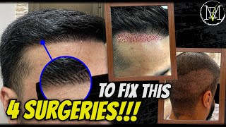 Hair Transplant Horror Story  Repair Case Analysis [upl. by Gauthier]