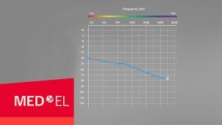 Audiograms Explained  MEDEL [upl. by Laurance]