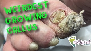 Weirdest Growing Callus by Dr Binh Nguyen Large Callus on Toe [upl. by Osher]