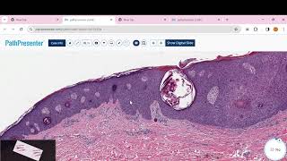 irritated Seborrheic Keratosis [upl. by Nylodnew]