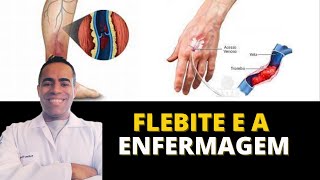 O que é flebite na enfermagem [upl. by Ahsyak]