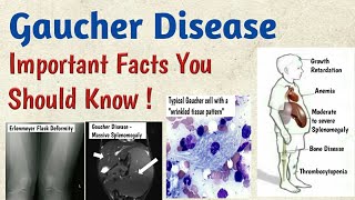 Gaucher Disease Symptoms Causes Types Complications Diagnosis amp Treatment [upl. by Oiramat]