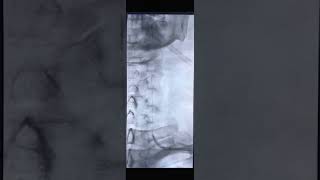 Treatment of Vertebral Artery Stenosis Radial Approach [upl. by Lomasi]