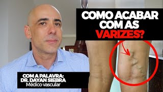 COMO ACABAR COM AS VARIZES Eu sou médico vascular você sabia  Dr Dayan Siebra varizes saude [upl. by Ydok940]