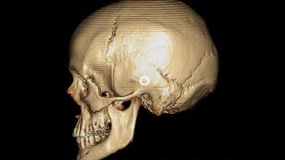 ANATOMIE FMPM OSTÉOLOGIE DU CRANE VS22 [upl. by Waldo]