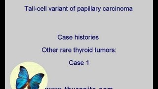 Tall cell variant of papillary carcinoma Other rare tumors  case 1 [upl. by Hniht]