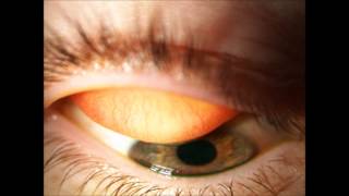 Contact lenses  External examination [upl. by Nekcarb]