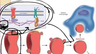 HLS Pathology  Hereditary Spherocytosis [upl. by Goldwin807]