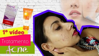 1ª Video Tratamento da acne com Tetraciclina e Creme Adapaleno [upl. by Coughlin]