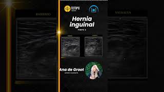 Hernia inguinal y ecografía parte 2 con Ana de Groot ecografia fisioterapia [upl. by Celestyna]