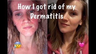 How I Cured My Perioral Dermatitis [upl. by Cedar526]